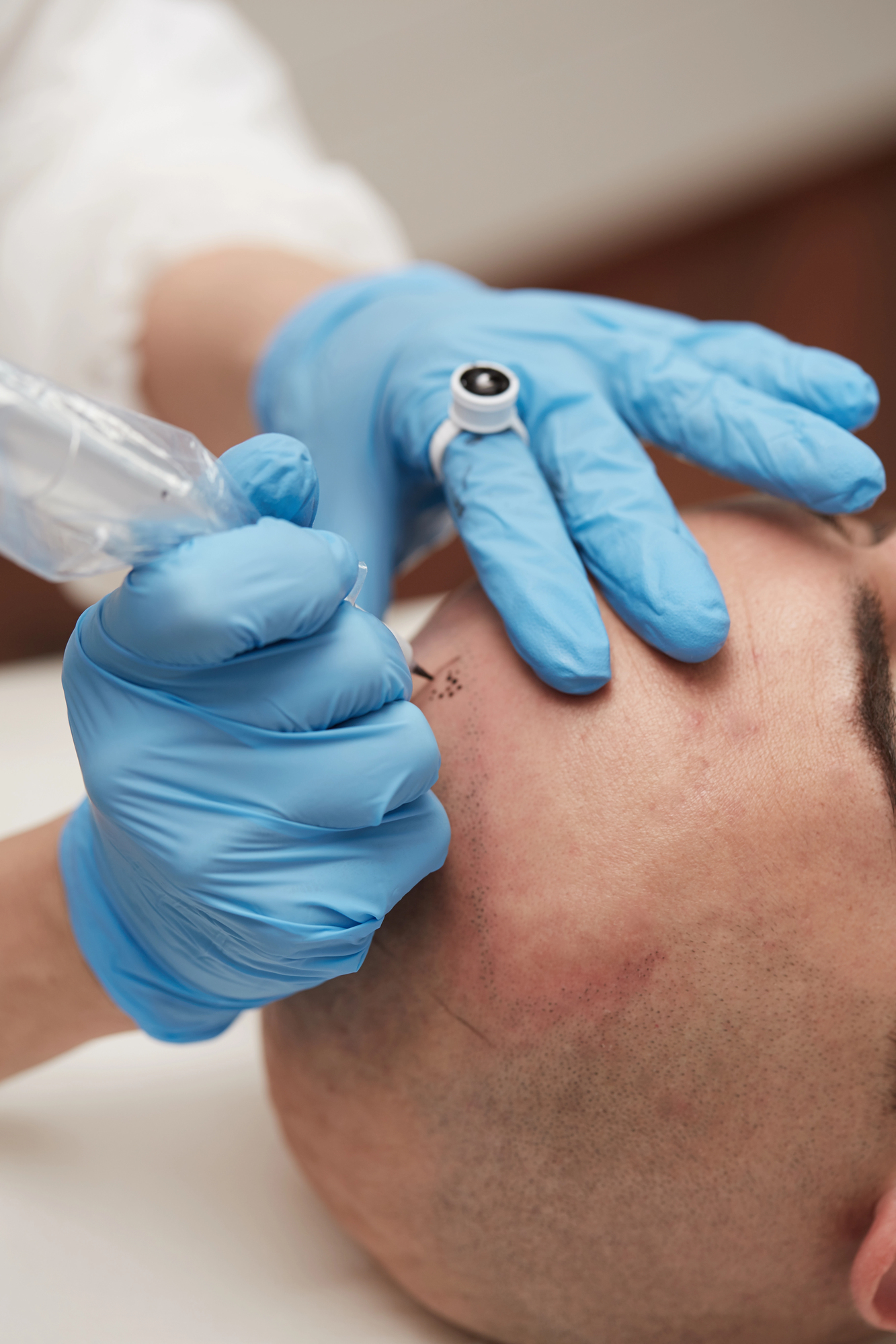Scalp micropigmentation treatment procedure.